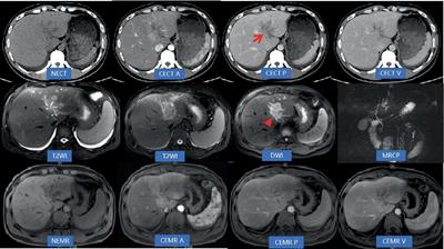 Case report: Rare benign obstructive disease of the biliary tract—a rare case of eosinophilic cholangitis